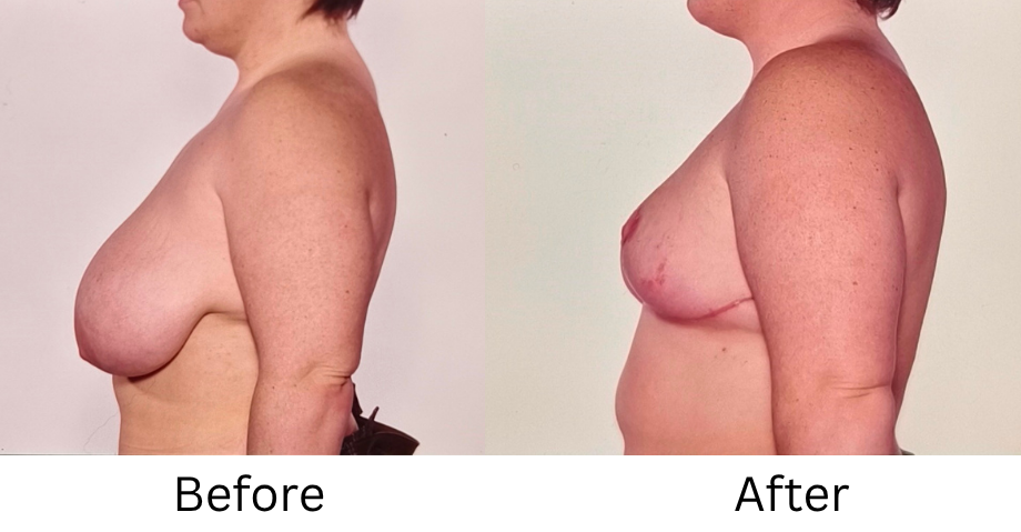 Breast Reduction