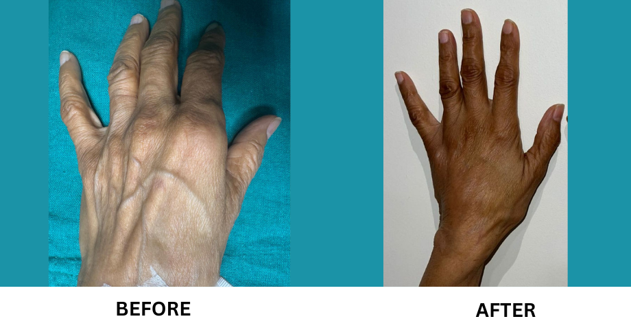 Fat Grafting Hand