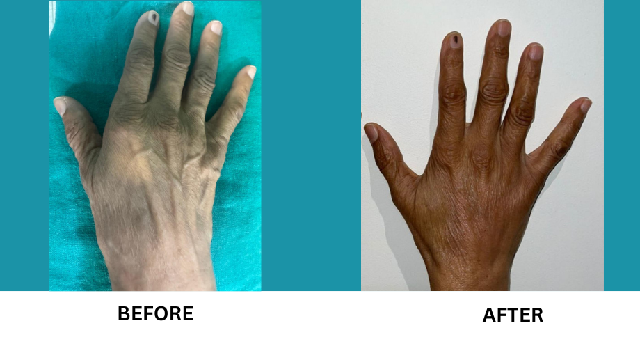Fat Grafting Hand